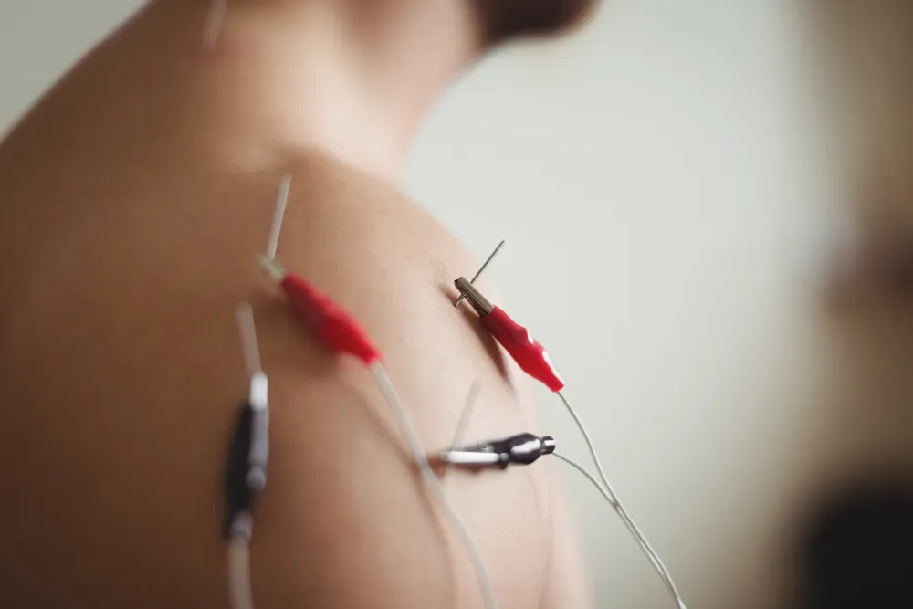 Acupuncture